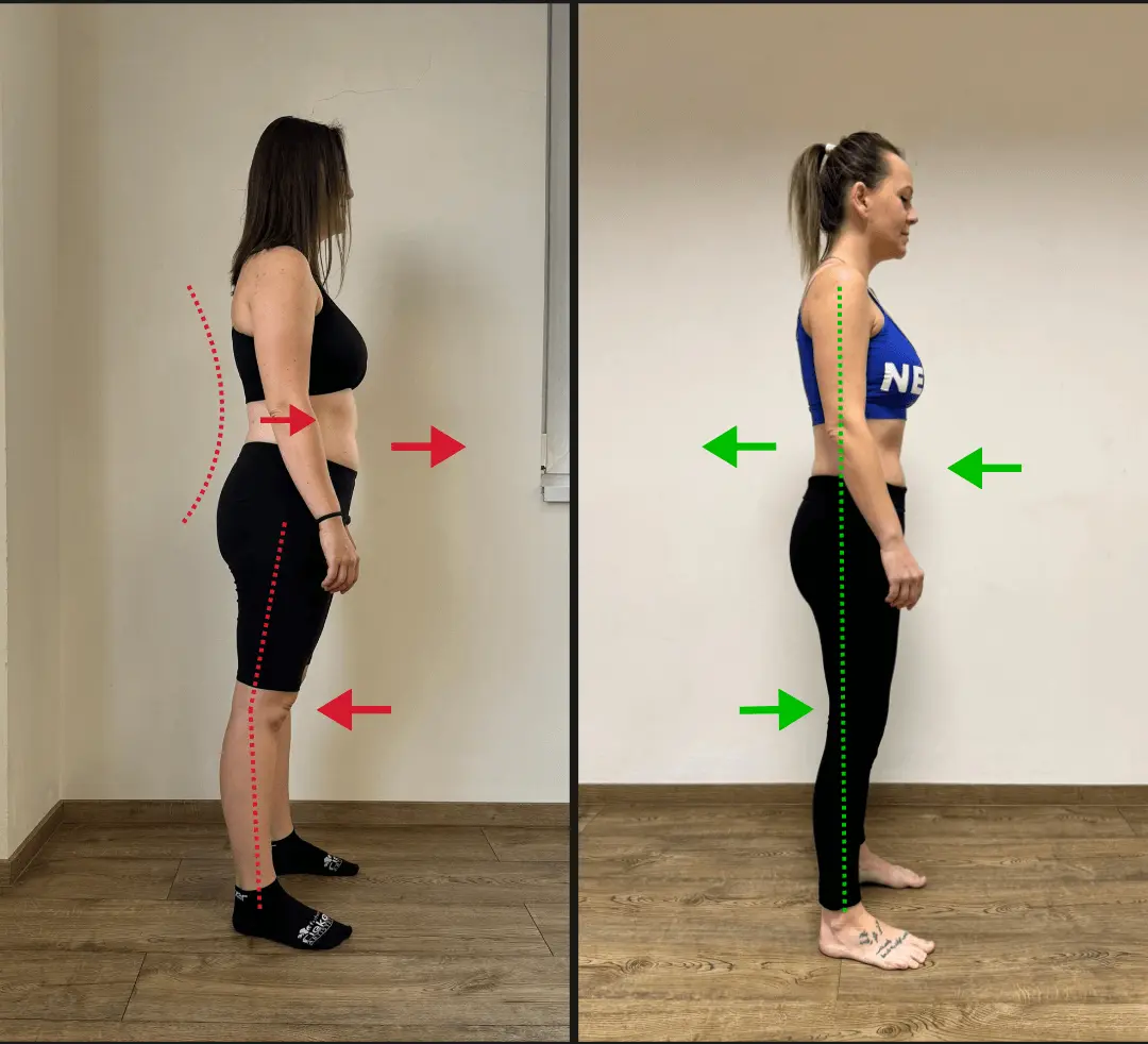 Before and after: poor posture and pelvic tilt — full structural correction