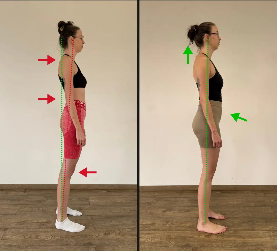Before and after: compressed posture and kyphosis — alignment corrected